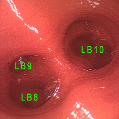 Beschriftete Innenansicht des Bronchoskopie-Trainers mit LB8, LB9 und LB10