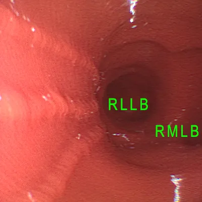 Beschriftete Innenansicht des Bronchoskopie-Trainers mit RLLB und RMLB